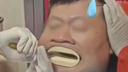 太尴尬！男子吃面被鸡骨卡喉 去医院取骨又被嘴套卡