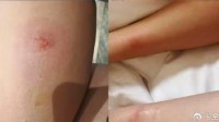 亚朵酒店住客称遭虫咬10处伤 经理：天气炎热 没办法