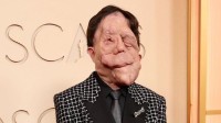 残障毁容演员亮相奥斯卡！面部布满良性肿瘤